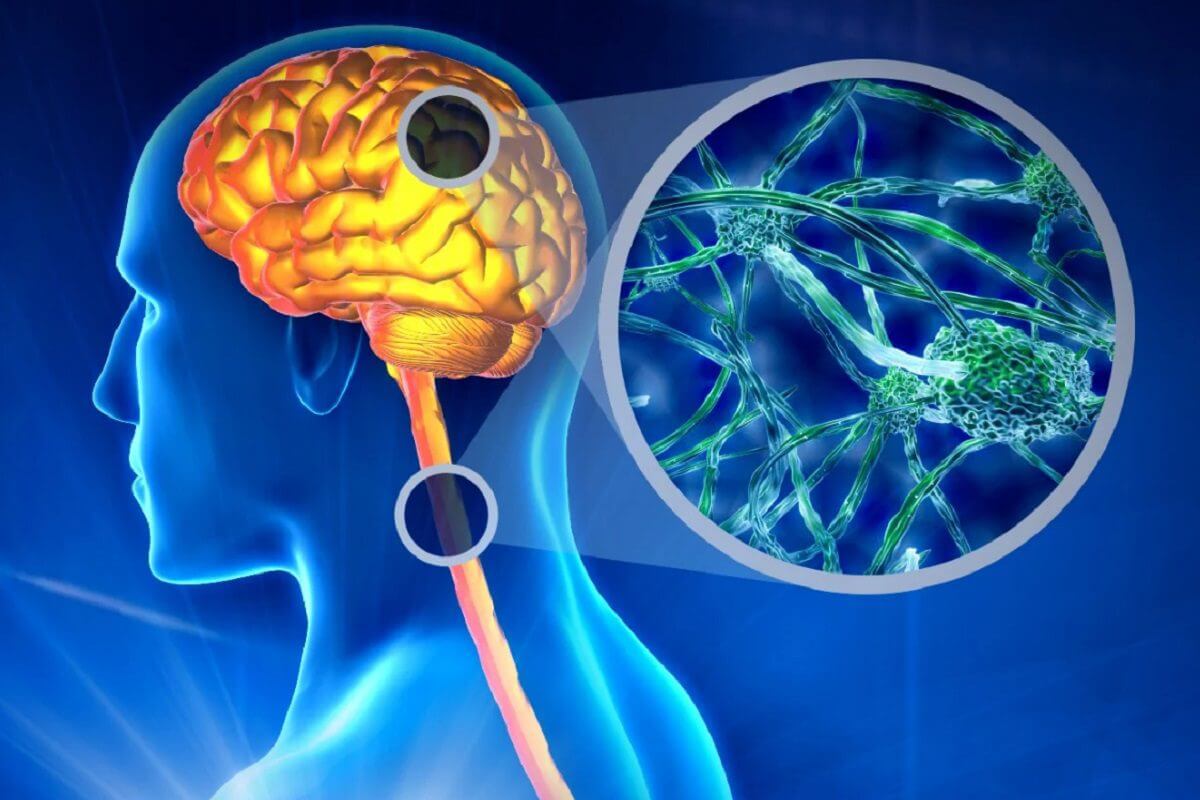 ESCLEROSE MÚLTIPLA: TRATAMENTO TEM COBERTURA PELO PLANO DE SAÚDE
